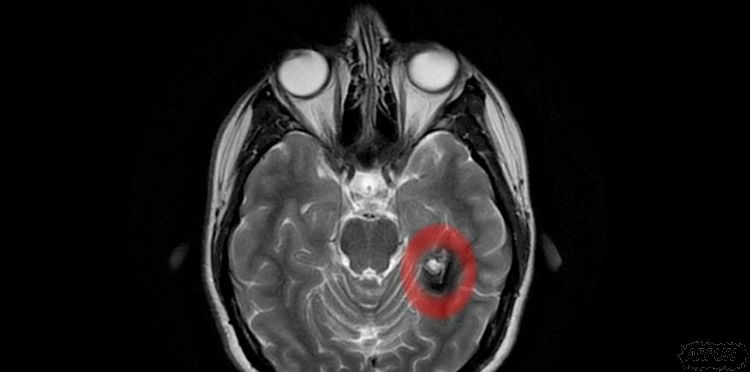 神经学家确认宗教信仰可能与脑损伤有关