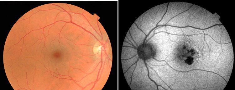 科学家注射病毒到眼睛里反转了老化眼盲的症状!